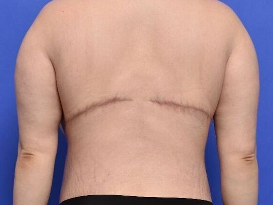 Torsoplasty: Case 2 - After