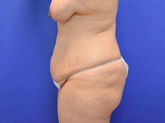 Massive Weight Loss patients: Case 1 - Before