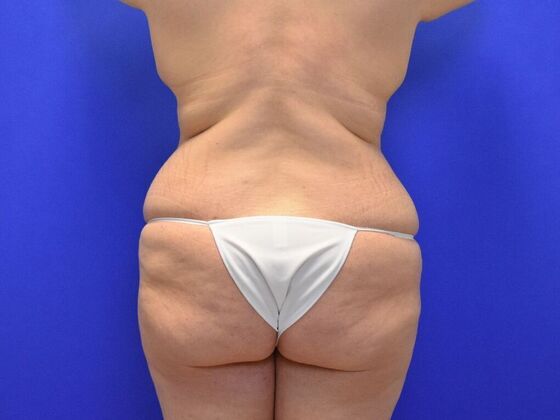 Massive Weight Loss patients: Case 1 - Before
