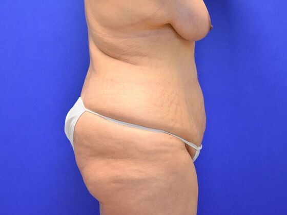 Massive Weight Loss patients: Case 1 - Before