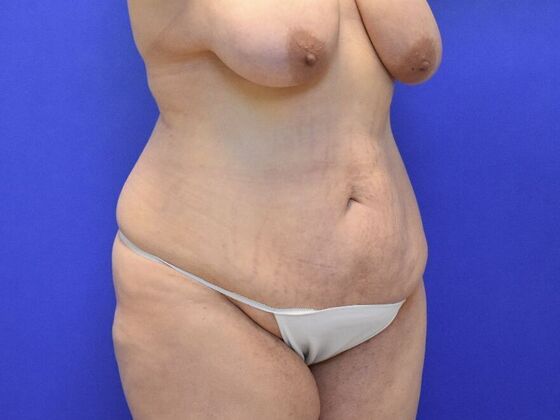 Massive Weight Loss patients: Case 1 - Before