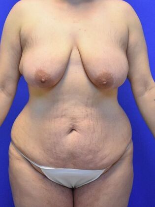 Massive Weight Loss patients Case 1 - Before