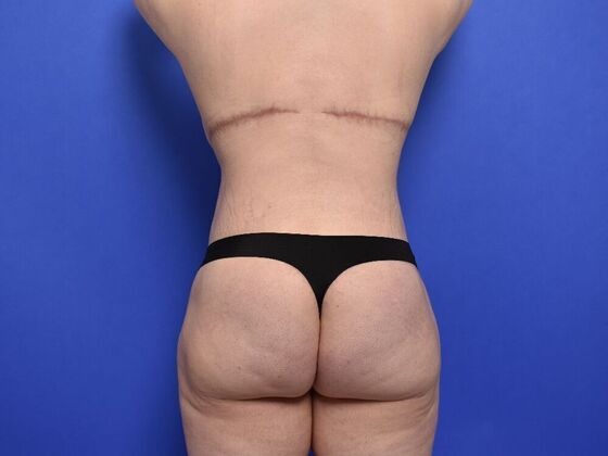 Massive Weight Loss patients: Case 1 - After