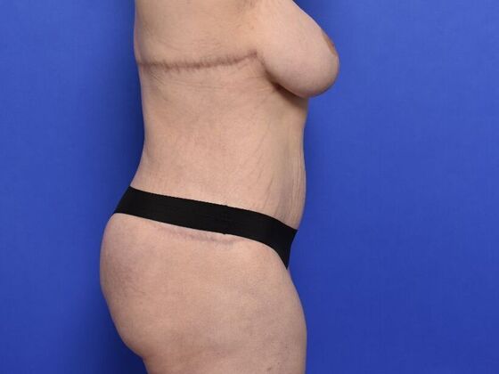 Massive Weight Loss patients: Case 1 - After
