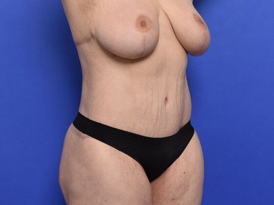 Massive Weight Loss patients: Case 1 - After