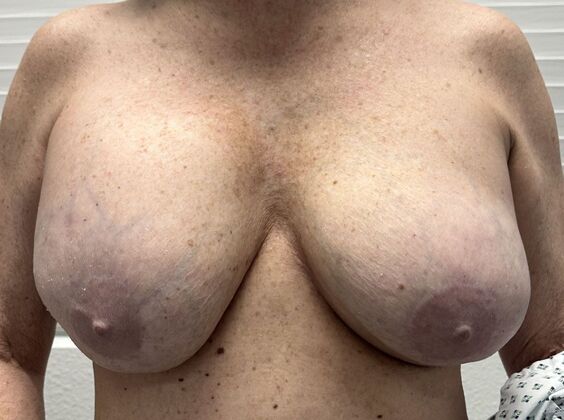 Breast Revision Case 12 - Before