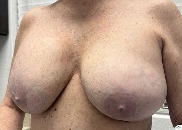 Breast Revision: Case 12 - Before