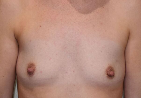 Breast Augmentation Case 830 - Before
