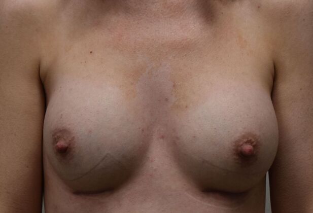 Breast Augmentation Case 830 - After
