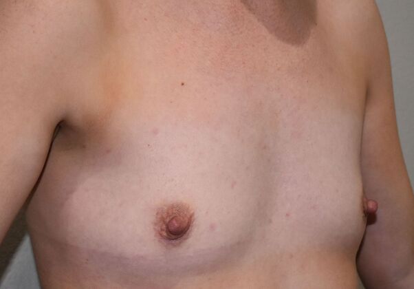 Breast Augmentation: Case 830 - Before