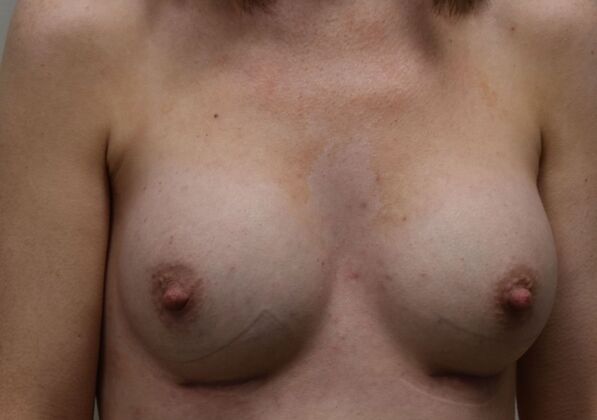 Breast Augmentation: Case 830 - After