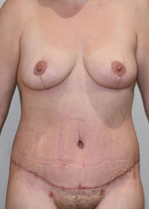 Mommy Makeover Case 9a - After