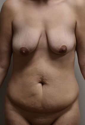 Massive Weight Loss  Case 222 - Before