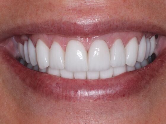 Full Mouth Rehabilitation Case 10: Alex - After