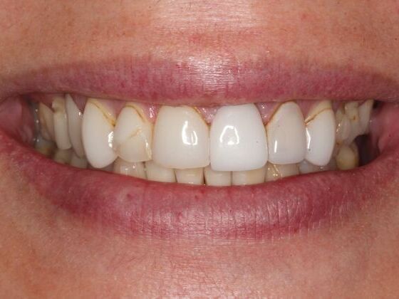 Full Mouth Rehabilitation Case 10: Alex - Before