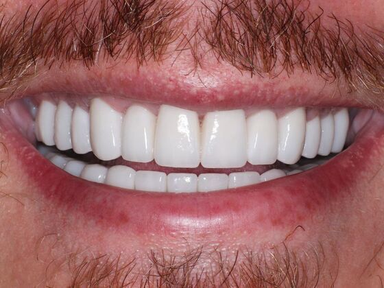 Smile Makeover Case 1: Travis - After
