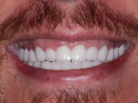 Smile Makeover Case 1: Travis - Before