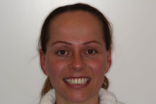 Veneers: Case 3: Amber - Before