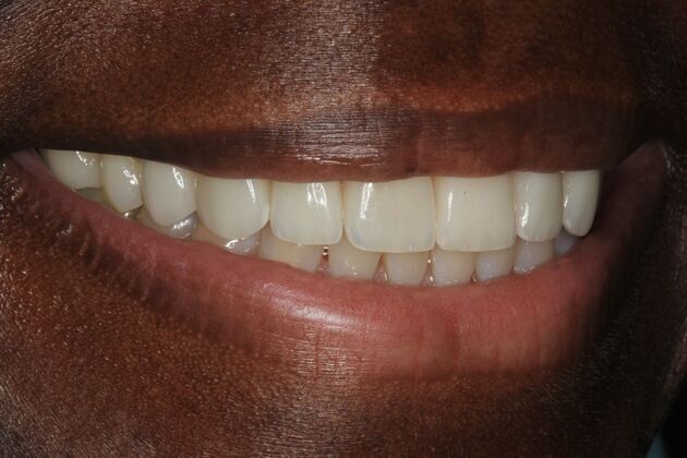 Veneers: Case 4 - After