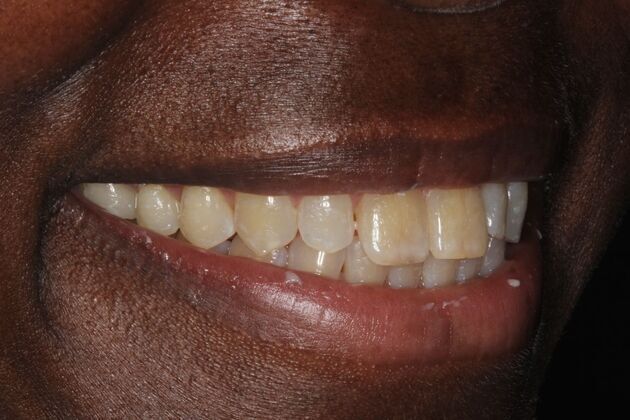Veneers: Case 4 - Before