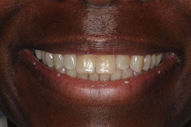 Veneers: Case 4 - Before