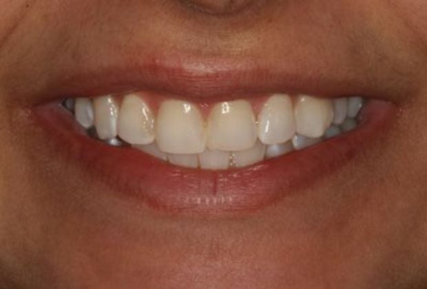Veneers Case 5: Jowana - Before