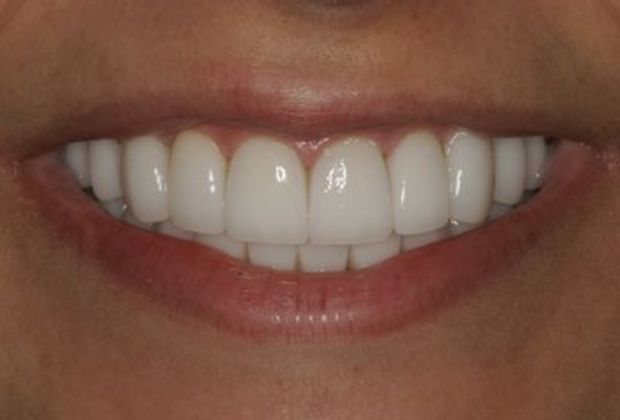Veneers Case 5: Jowana - After