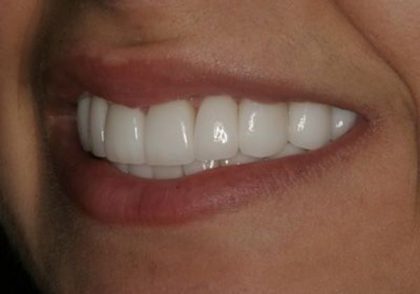 Veneers: Case 5: Jowana - After