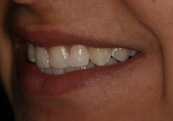 Veneers: Case 5: Jowana - Before