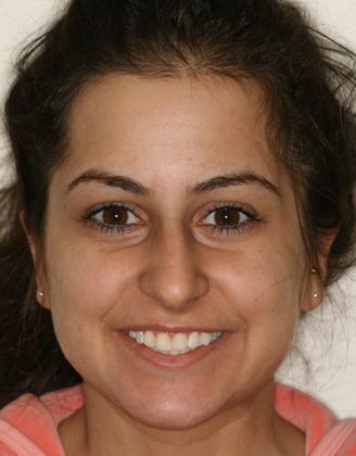 Veneers: Case 5: Jowana - Before