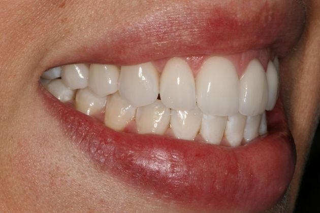 Veneers: Case 6 - After