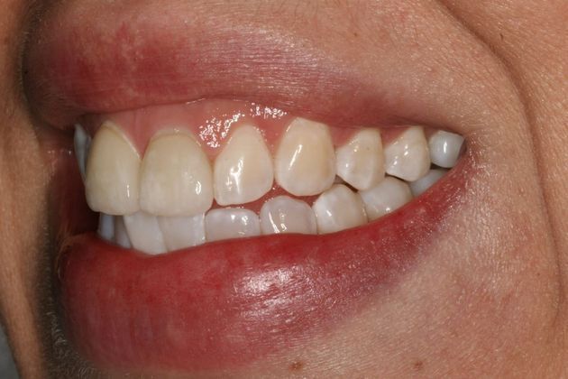 Veneers: Case 6 - Before