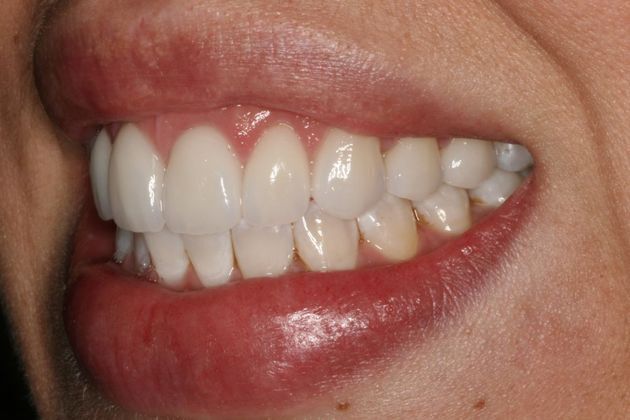 Veneers: Case 6 - After