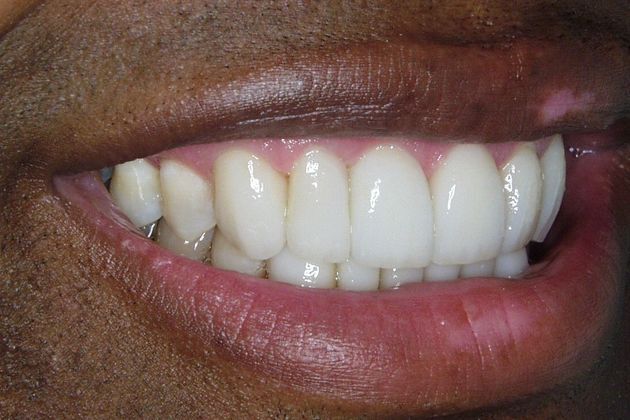 Veneers: Case 7: Bill - After