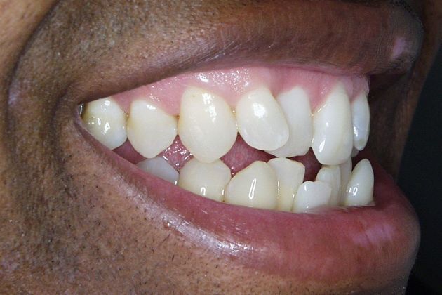 Veneers: Case 7: Bill - Before