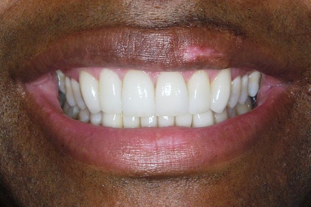 Veneers: Case 7: Bill - After