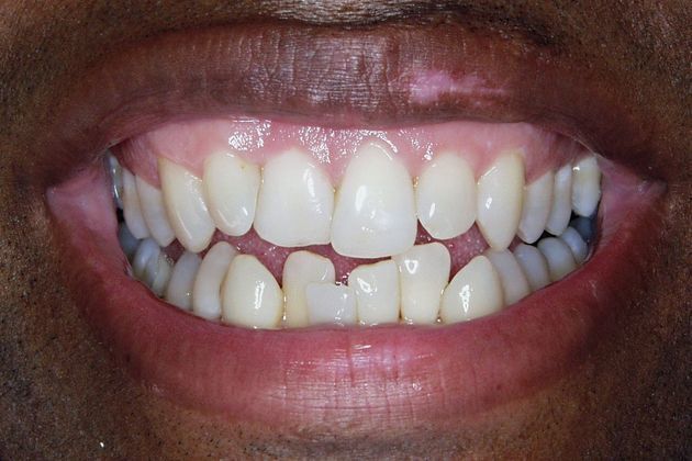 Veneers: Case 7: Bill - Before