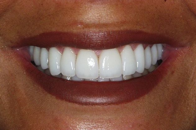 Veneers Case 8: Michelle - After