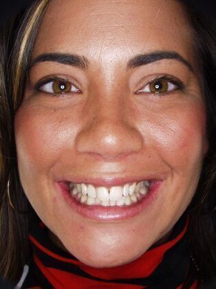 Veneers: Case 8: Michelle - Before
