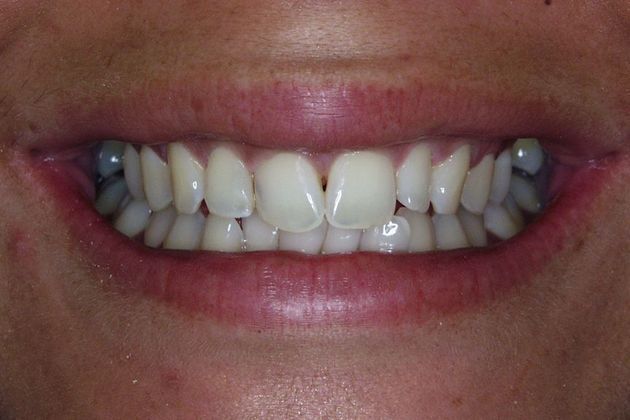 Veneers Case 8: Michelle - Before