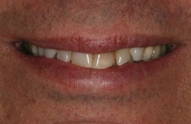 Veneers: Case 9 - Before