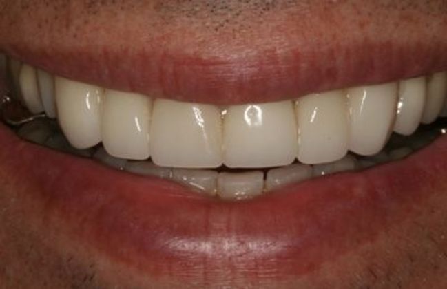 Veneers: Case 9 - After