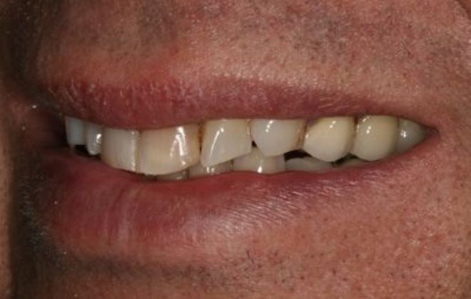 Veneers: Case 9 - Before