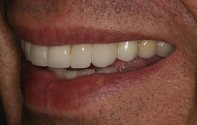 Veneers: Case 9 - After