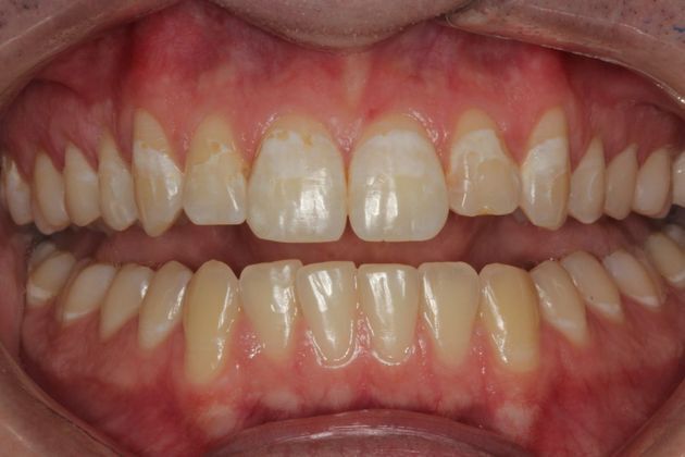 Veneers: Case 11 - Before