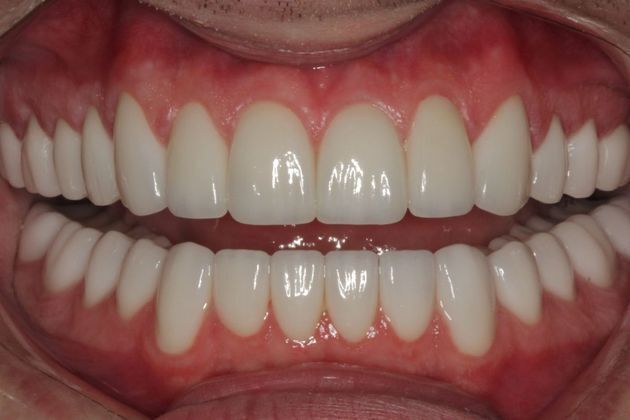Veneers: Case 11 - After
