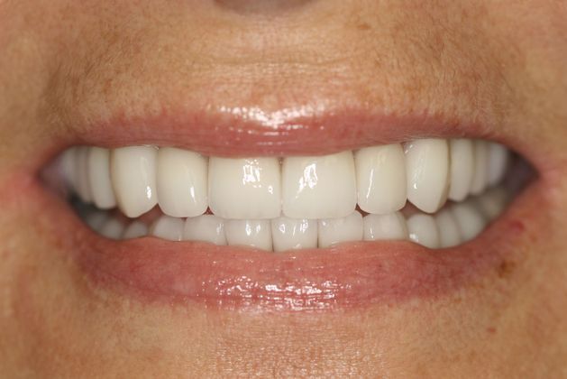 Veneers: Case 10 - After