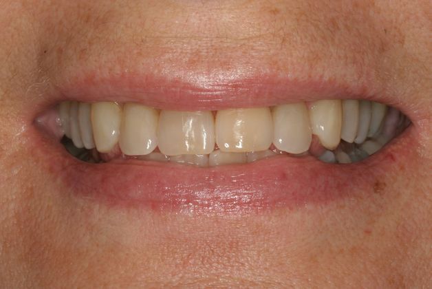 Veneers: Case 10 - Before