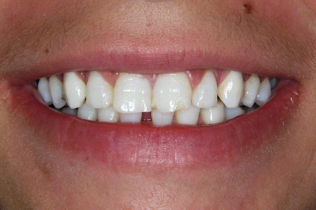 Veneers: Case 12 - Before