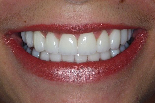 Veneers: Case 12 - After